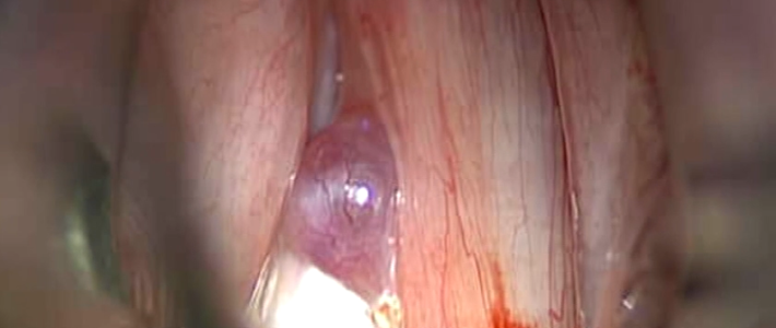 Chirurgie d’un polype en laryngoscopie en suspension au laser C02 (A. Giovanni)